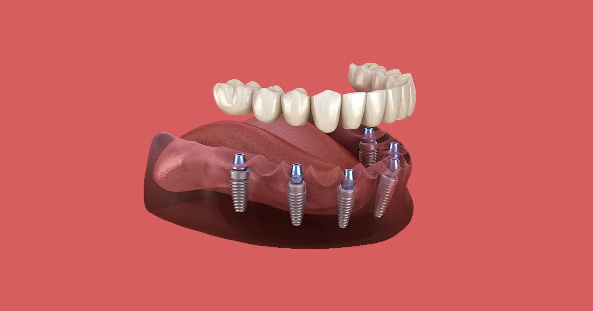 Rediscovering Taste: How Dental Implants Enhance Your Culinary Experience