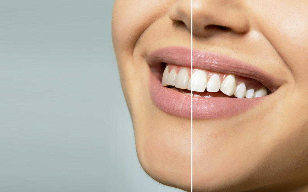 Personalised Teeth Whitening: Tailoring Treatments for Optimal Results