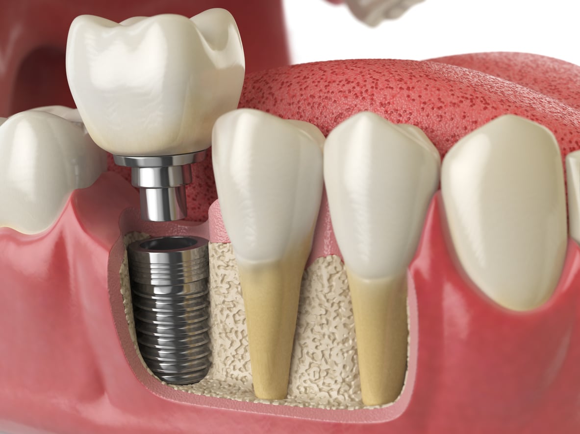 How Full Arch Dental Implant Techniques Provide Stable Solutions for Complete Tooth Loss Rehabilitation
